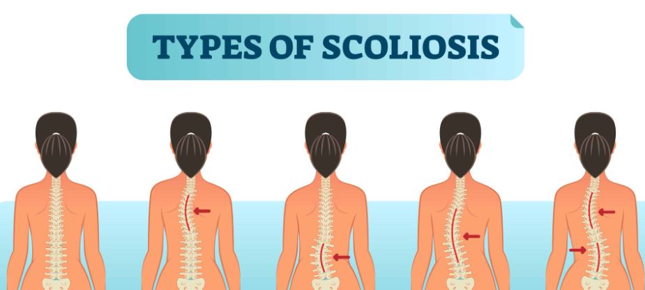 Understanding Scoliosis: Causes, Symptoms, and Treatment Options